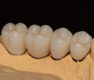 Монолитные коронки из диоксида циркония — стоматология «Премьера» ☎ +7 (812) 305-90-18