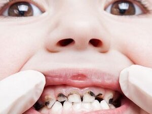 Лечение периодонтита у детей — стоматология «Премьера» ☎ +7 (812) 305-90-18