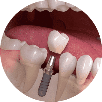 Имплантация зубов нижней челюсти в СПб — стоматология «Премьера» ☎ +7 (812) 305-90-18