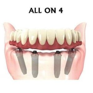 Имплантация при полном отсутствии зубов на нижней челюсти в СПб — стоматология «Премьера» ☎ +7 (812) 305-90-18