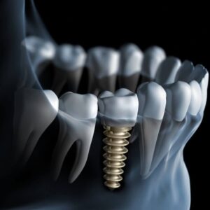 Имплантация нижней челюсти в СПб под ключ — стоматология «Премьера» ☎ +7 (812) 305-90-18
