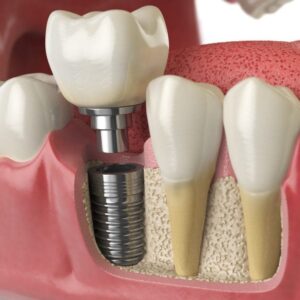 Имплантация нижних жевательных зубов в СПб — стоматология «Премьера» ☎ +7 (812) 305-90-18