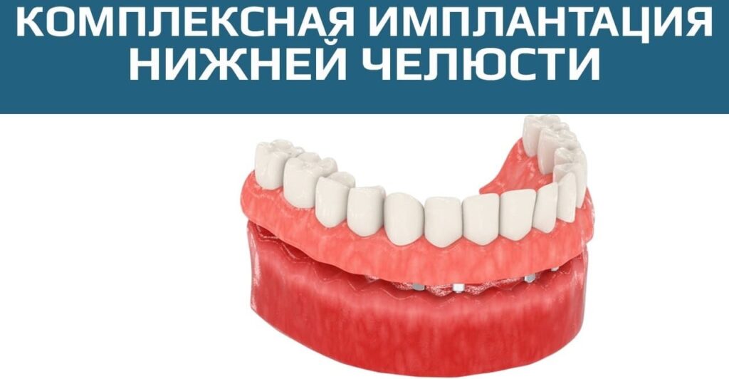 Имплантация зубов на нижней челюсти под ключ в СПб — стоматология «Премьера» ☎ +7 (812) 305-90-18