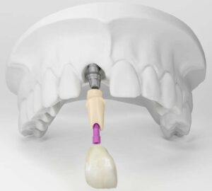 Имплантация верхних передних зубов в СПб — стоматология «Премьера» ☎ +7 (812) 305-90-18