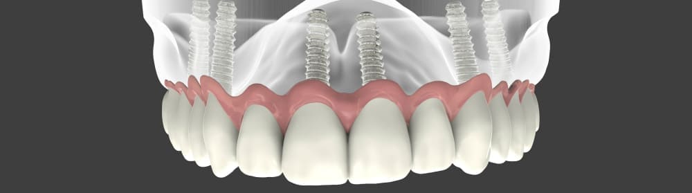 Имплантация зубов на верхней челюсти в СПб под ключ — стоматология «Премьера» ☎ +7 (812) 305-90-18