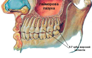 Синус-лифтинг при имплантации верхней челюсти — стоматология «Премьера» ☎ +7 (812) 305-90-18 Богатырский 55