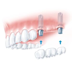 Имплантация верхних жевательных зубов в СПб — стоматология «Премьера» ☎ +7 (812) 305-90-18