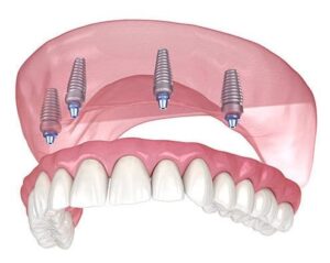 Имплантация верхней челюсти при полном отсутствии зубов в СПб — стоматология «Премьера» ☎ +7 (812) 305-90-18