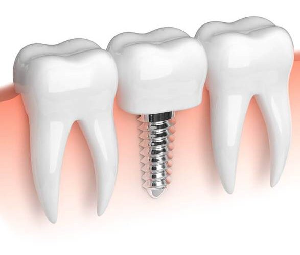 Установка дентальных имплантов под ключ — стоматология «Премьера» в Приморском районе ☎ +7 (812) 305-90-18