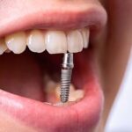 Имплантация под ключ недорого в стоматологии «Премьера» на Богатырском ☎ +7 (812) 305-90-18