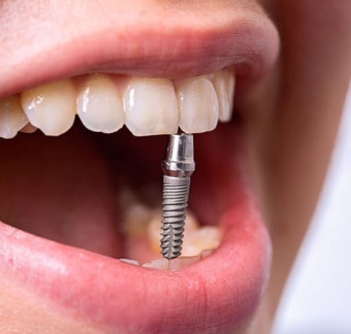 Имплантация под ключ недорого в стоматологии «Премьера» на Богатырском ☎ +7 (812) 305-90-18