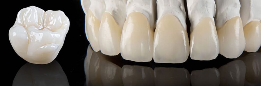 Протезирование зубов керамическими коронками в СПб — стоматология «Премьера» ☎ +7 (812) 305-90-18