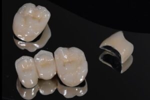 Поставить металлокерамику на зубы недорого в СПб — стоматология «Премьера» ☎ +7 (812) 305-90-18