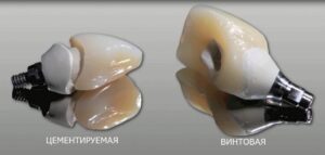 Металлокерамические коронки на имплантах в СПб — стоматология «Премьера» ☎ +7 (812) 305-90-18