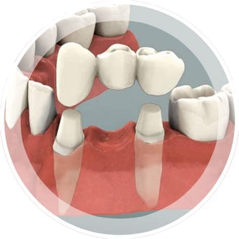 Протезирование зубов несъемными протезами в СПб — стоматология «Премьера» ☎ +7 (812) 305-90-18