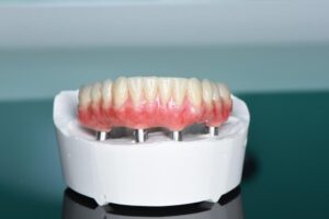 Несъемные протезы на имплантах под ключ в СПб — стоматология «Премьера» ☎ +7 (812) 305-90-18