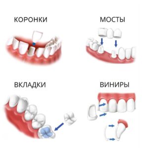 Несъемные зубные протезы по низким ценам в СПб — стоматология «Премьера» ☎ +7 (812) 305-90-18