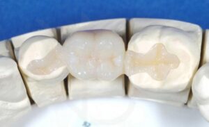 Вкладки на зубы недорого в СПб — стоматология «Премьера» ☎ +7 (812) 305-90-18