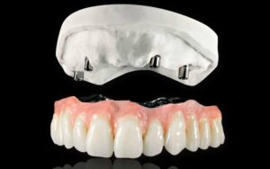 Несъемный покрывной протез на имплантах под ключ — стоматология «Премьера» ☎ +7 (812) 305-90-18