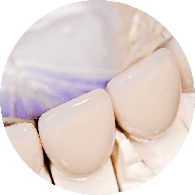 Протезирование передних зубов в Санкт-Петербурге — стоматология «Премьера» ☎ +7 (812) 305-90-18