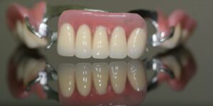 Протезирование передних зубов под ключ — стоматология «Премьера» ☎ +7 (812) 305-90-18