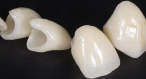 Протезирование передних зубов коронками — стоматология «Премьера» ☎ +7 (812) 305-90-18