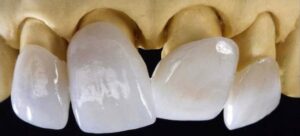 Виниры на передние зубы в СПб недорого — стоматология «Премьера» ☎ +7 (812) 305-90-18
