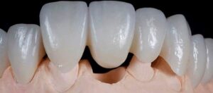 Мостовидный протез на передние зубы под ключ — стоматология «Премьера» ☎ +7 (812) 305-90-18