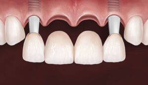 Протезирование передних зубов на имплантах под ключ — стоматология «Премьера» ☎ +7 (812) 305-90-18