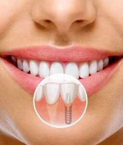 Зубные протезы передних зубов в СПб недорого — стоматология «Премьера» ☎ +7 (812) 305-90-18 Богатырский 55