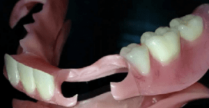 Протезы Quattro Ti («Квадротти») на передние зубы в СПб — стоматология «Премьера» ☎ +7 (812) 305-90-18