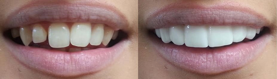 Протезирование передних зубов под ключ по низким ценам — стоматология «Премьера» ☎ +7 (812) 305-90-18