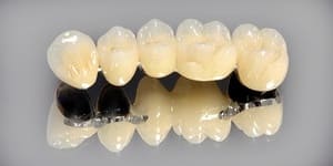 Протезирование жевательных зубов под ключ — стоматология «Премьера» ☎ +7 (812) 305-90-18