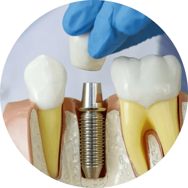 Протезы на жевательные зубы под ключ в СПб — стоматология «Премьера» ☎ +7 (812) 305-90-18