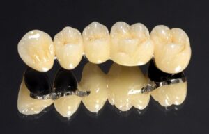 Мостовидный протез на жевательные зубы в СПб — стоматология «Премьера» ☎ +7 (812) 305-90-18