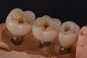 Импланты на жевательные зубы под ключ в СПб — стоматология «Премьера» ☎ +7 (812) 305-90-18