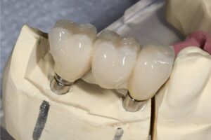 Протезирование моляров и премоляров в СПб под ключ — стоматология «Премьера» ☎ +7 (812) 305-90-18