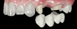 Протезирование жевательных зубов под ключ по низким ценам — стоматология «Премьера» ☎ +7 (812) 305-90-18