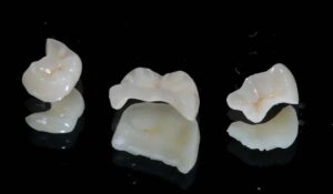 Протезирование жевательных зубов вкладками недорого — стоматология «Премьера» ☎ +7 (812) 305-90-18