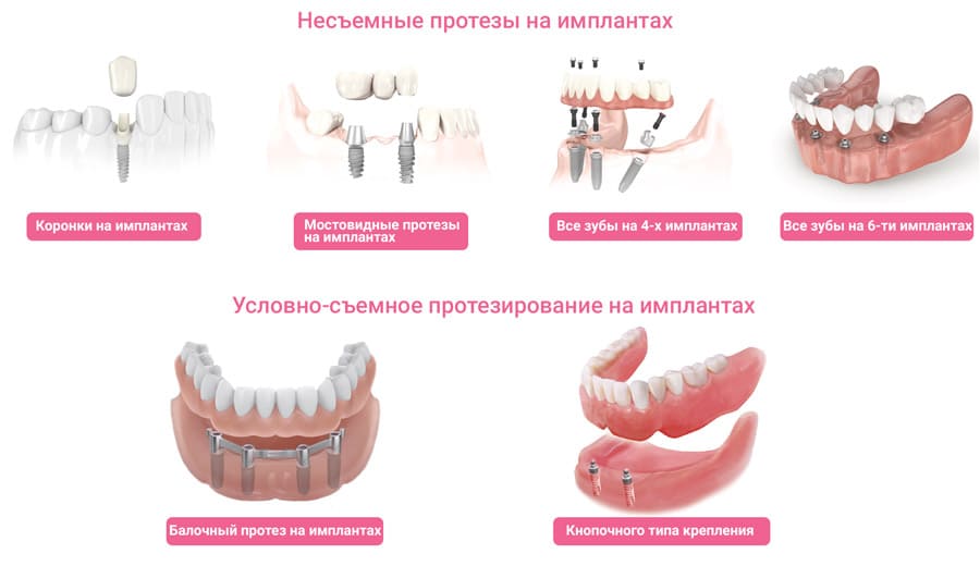 Протезирование на имплантатах под ключ в СПб недорого — стоматология «Премьера» ☎ +7 (812) 305-90-18