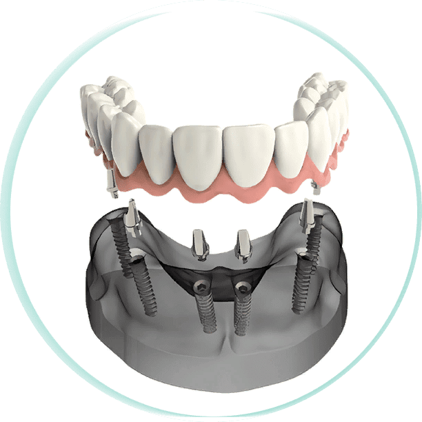 Протезирование зубов на имплантатах в СПб — стоматология «Премьера» на Богатырском ☎ +7 (812) 305-90-18