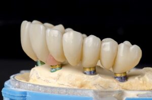 Зубной мост на имплантах под ключ в СПб — стоматология «Премьера» ☎ +7 (812) 305-90-18