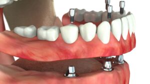 Полный покрывной протез на имплантах — стоматология «Премьера» ☎ +7 (812) 305-90-18