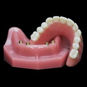 Условно-съемный протез на имплантах — стоматология «Премьера» ☎ +7 (812) 305-90-18