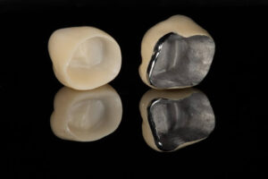 Металлокерамические коронки на зубы под ключ в СПб — стоматология «Премьера» ☎ +7 (812) 305-90-18