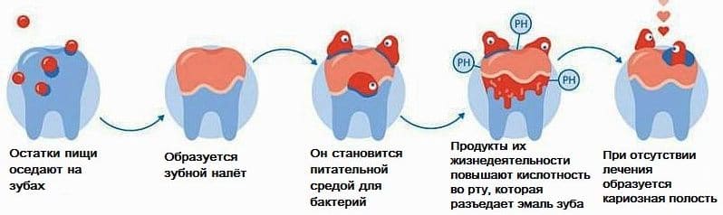 Причины развития кариеса зубов — стоматология «Премьера» на Богатырском ☎ +7 (812) 305-90-18