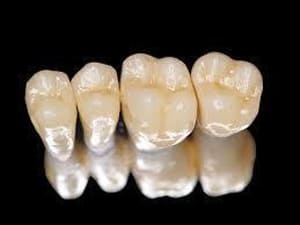 Зубные коронки в СПб недорого — стоматология «Премьера» ☎ +7 (812) 305-90-18 Богатырский 55