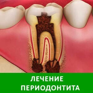 Лечение периодонтита в СПб — стоматология «Премьера» на Богатырском пр. ☎ +7 (812) 305-90-18