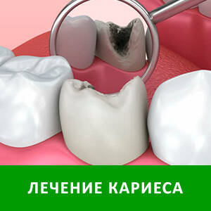 Лечение кариеса в СПб — стоматология «Премьера» на Богатырском пр. ☎ +7 (812) 305-90-18