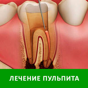 Лечение пульпита в СПб — стоматология «Премьера» на Богатырском пр. ☎ +7 (812) 305-90-18